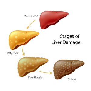stages of liver damage - Nash24x7